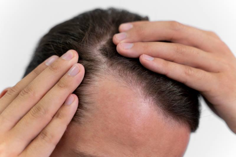 ZAUSTAVITE OPADANJE KOSE: Uzroci gubitka kose i kako ih spriječiti!